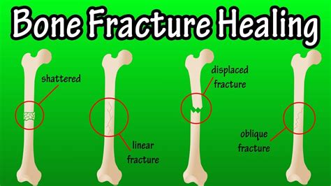 how-long-for-broken-bone-to-heal broken bone healing process