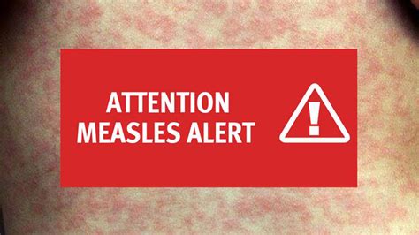measles outbreak health alert