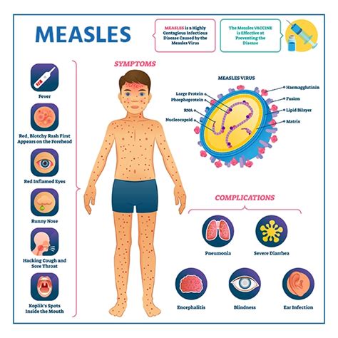 measles symptoms and treatment