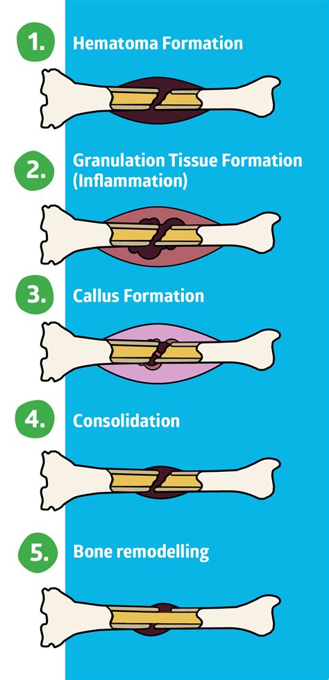 how-long-to-recover-from-broken-bone broken bone healing recovery