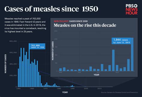 measles outbreak public health data